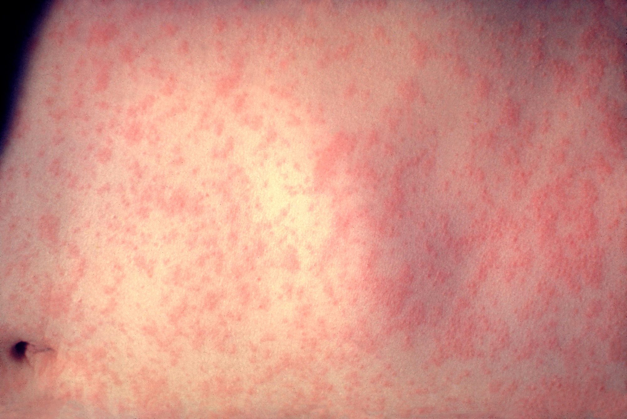 This is the skin of a patient after 3 days of measles infection; treated at the New York - Presbyterian Hospital.
Prior to widespread immunization, measles was common in childhood, with more than 90% of infants and children infected by age 12. Recently, fewer than 1,000 measles cases have been reported annually since 1993.