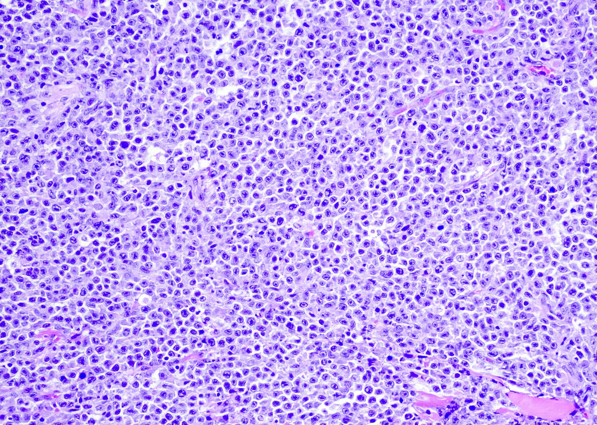Diffuse large B-cell lymphoma.