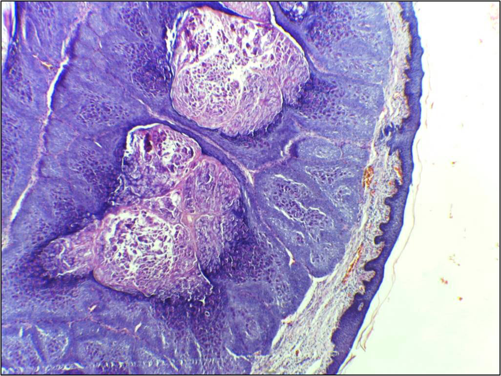 Microscope slide showing purple-stained skin tissue with rounded lobular structures.