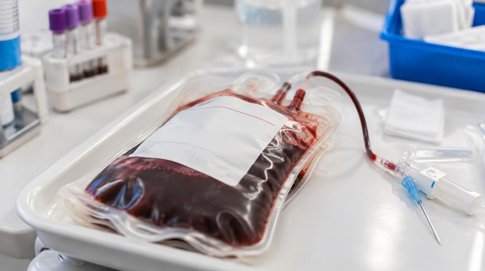 A blood donation bag partially filled with dark red blood beside sterile tubing.